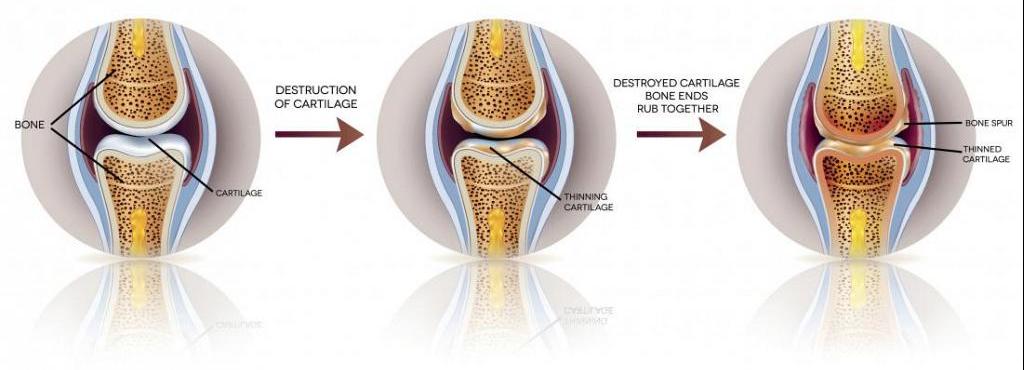 tratamentul uzurii articulațiilor genunchiului