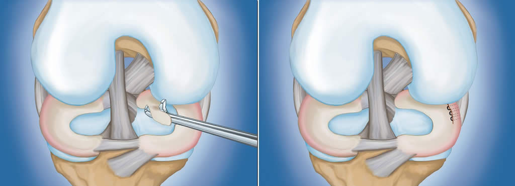 tratamentul artroscopic al afectării meniscului la genunchi deformarea artrozei tratamentului articulațiilor falangiene