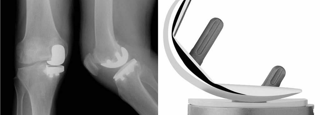 Proteza de genunchi unicompartimentală: indicații, avantaje și experiența chirurgului