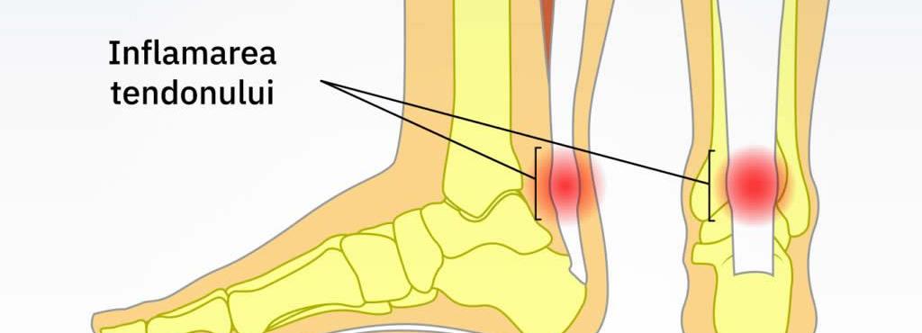 artróza pohyb durere în oasele picioarelor și articulațiilor mâinilor