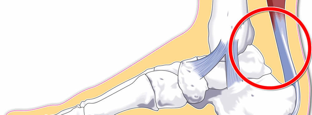 articulațiile tendonului piciorului și tratamentul acestora