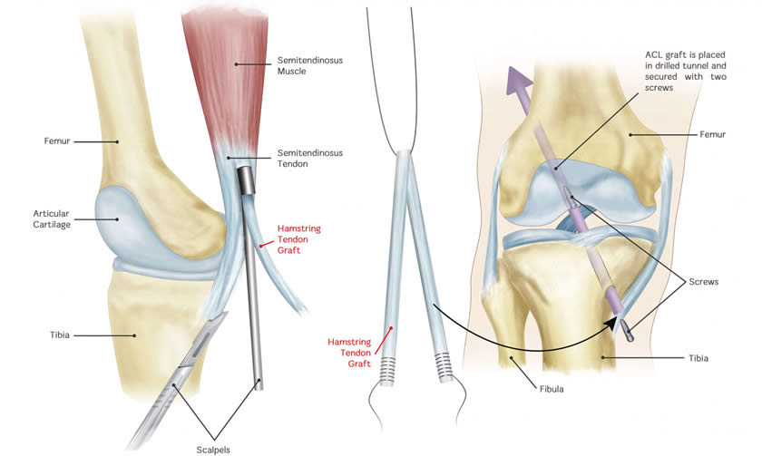 program recuperare ligamentoplastie hemartroza genunchiului