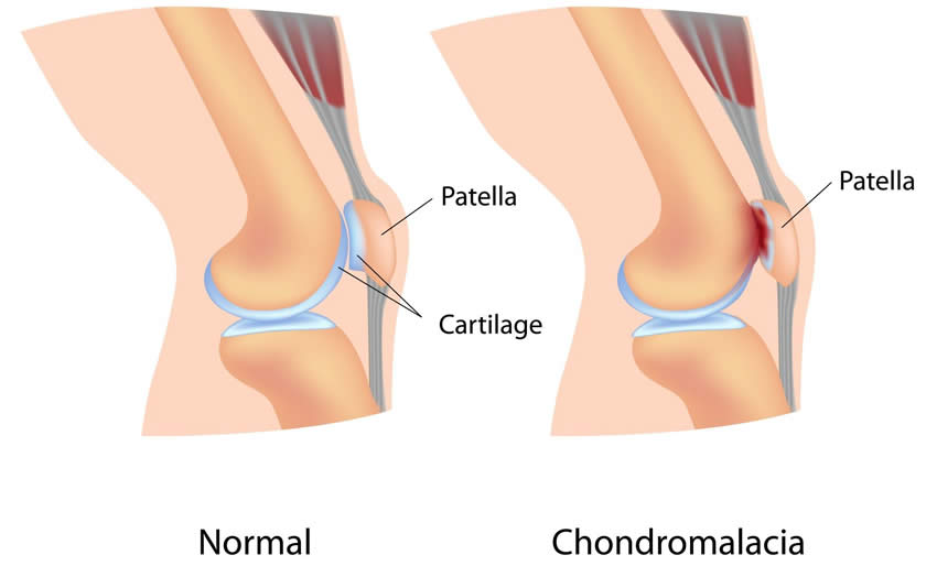 Gonartroza articulațiilor genunchiului 2 grade: cauze, simptome, tratament