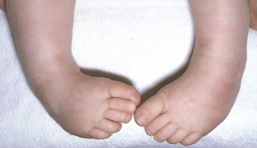 Protocol recuperare picior stramb congenital