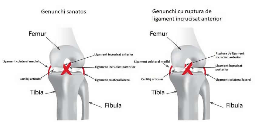 Recuperare după sfâșierea ligamentelor cruciate ale articulației genunchiului