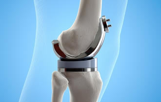 Recuperarea dupa proteza de genunchi
