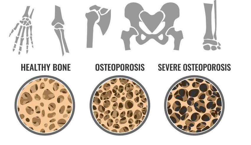 Osteoporoza: cauze, simptome si tratament | addamsscrub.ro