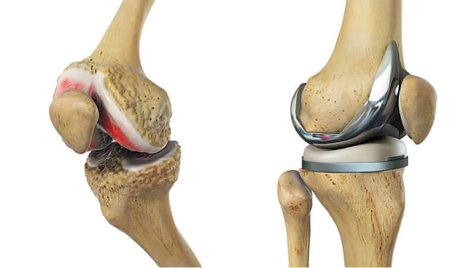 exfolierea cartilajului în tratamentul articulației genunchiului