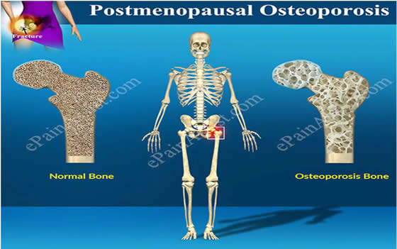 Osteoporoza, boala oaselor fragile: Simptome, tratament, dieta | Bioclinica