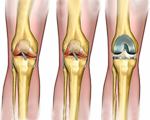 articulație de genunchi din titan
