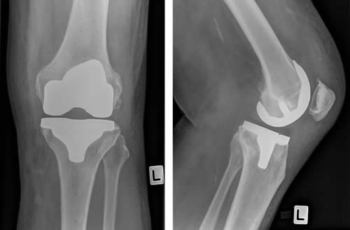 proteza genunchi gonartroza durere în articulația stângă