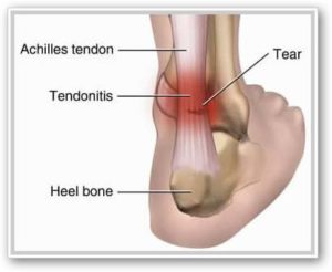 tendoanele piciorului)