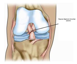 restaurarea ligamentelor și articulațiilor